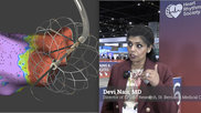 Devi Nair, MD, director of electrophysiology and research, St. Bernards Medical Center and Arrhythmia Research Group, spoke with Cardiovascular Business at the Heart Rhythm 2026 meeting in the above video interview. She explained both the explosion of PFA use since the first FDA approvals in 2024, and the recently discovered complications of coronary vessel spasm and hemolysis and how newer PFA technology might address this.