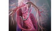 Jupiter Endovascular's Vertex Pulmonary Embolectomy System showed positive results in its SPIRARE II pivotal trial.