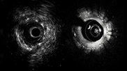 An example of the Novasight Hybrid System, showing its co-registered IVUS (left) and OCT intravascular imaging inside a coronary stent.