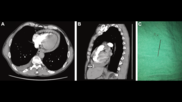 Accidentally swallowing a sewing needle could have cost one 54-year-old patient his life. His care team was persistent, however, exploring his unexplained symptoms until they identified the problem.