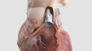 The Autus pulmonary heart valve is adjustable so it can grow with congenital heart patients as they age.
