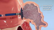 The Parasol Med Tech left atrial appendage closure (LAAO) system uses gel to completely fill and seal the LAA while a temporary shield prevents the gel from embolizing during delivery.