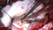 A mitral valve open heart surgical repair.