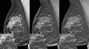 An example of architectural distortion in a 3D DBT mammogram, which is easier to see because the radiologist can look at the breast tissue layer-by-layer.