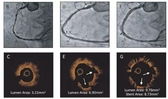  (OCT) intravascular images (bottom).