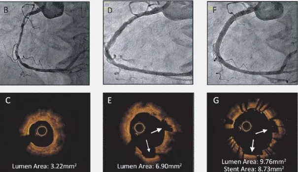 Angiogram images (top row) and optical coherence tomography (OCT) intravascular images (bottom).