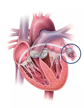 Illustration of a left atrial appendage occlusion (LAAO) procedure using a Watchman device. Image courtesy of Johns Hopkins Medicine. #LAA #LAAO