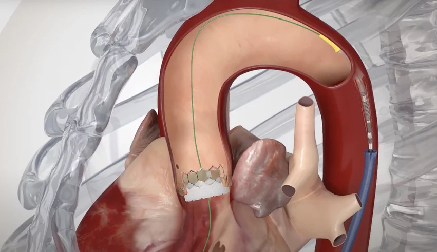 The Edwards Lifesciences Sapien transcatheter aortic valve replacement (TAVR) device in a heart model used to show patients how the device works.