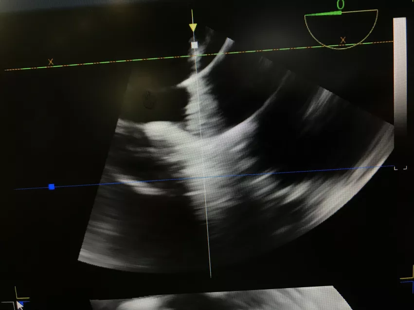 A MitraClip transcatheter mitral valve repair device visualized by a NuVision 4D intra-cardiac echo (ICE) catheter. The Biosense Webster catheter was co-developed with GE. It also can be used in place of TEE in  procedures to eliminate the need for an interventional echocardiography. 