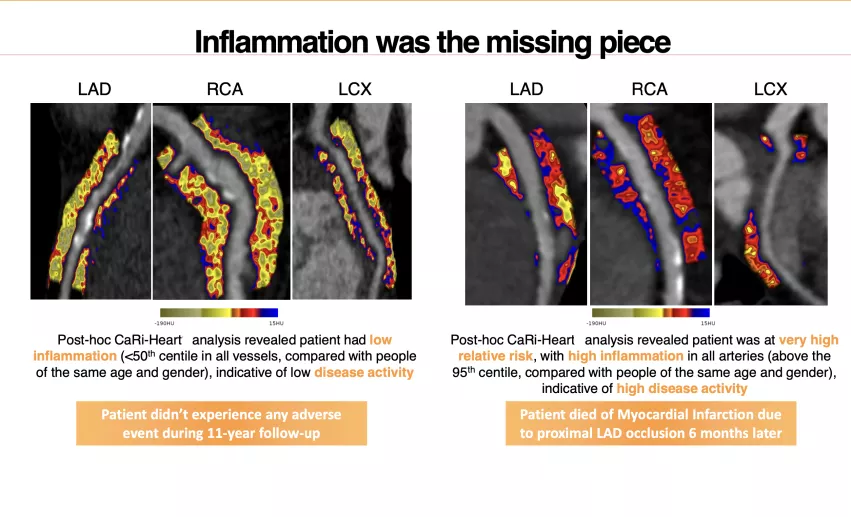 Examples of Caristo's fat attenuation index (FAI) CT imaging of coronary vessel fat to show inflammation. #SCCT #SCCT2022