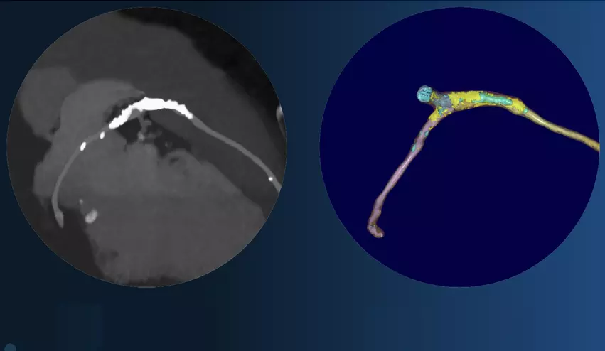 Left, coronary CT angiography of a vessel showing plaque heavy calcium burden. Right, image showing color code of various types of plaque morphology showing the complexity of these lesions. The right image was processed using the FDA cleared, AI-enabled plaque assessment from Elucid.