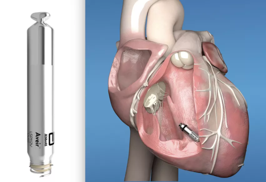 The Medtronic Micra, right, was the first leadless pacemaker cleared by the FDA in 2016. The Abbott Aveir VR, left, became the second to receive FDA clearance in March 2022. However, both are single chamber pacemakers, which limits their use to just 20% of patients requiring pacing, while 80% require dual chamber pacing. New iterations of these devices is now expanding patients that can be treated with this minimally invasive technology.