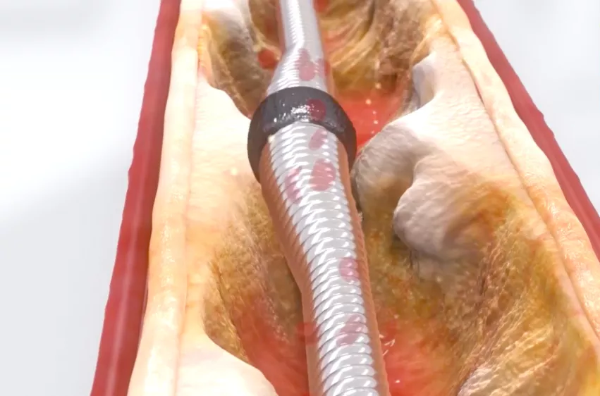 The CSI Diamondback 360 atherectomy system grinding through a calcified coronary lesion. 