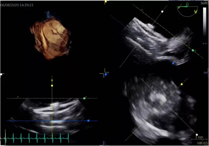 An Amulet LAA closure device visualized using 3D intracardiac echo (ICE) imaging using the Biosense Webster NuVision Ultrasound Catheter. 