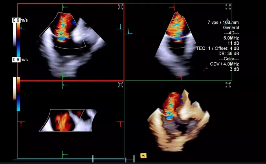 Color flow Doppler 3D ICE showing mitral regurgitation during a MitraClip procedure using the Siemens ICE system.
