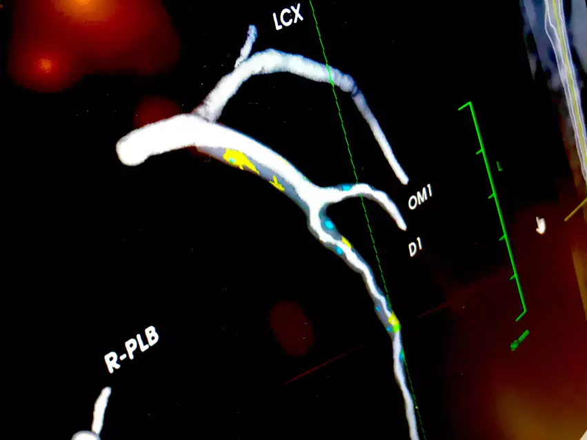 Soft plaque color-coded by type by artificial intelligence from a patient's coronary CT scan by Elucid's AI software. Photo by Dave Fornell #ACC23 #ACC  