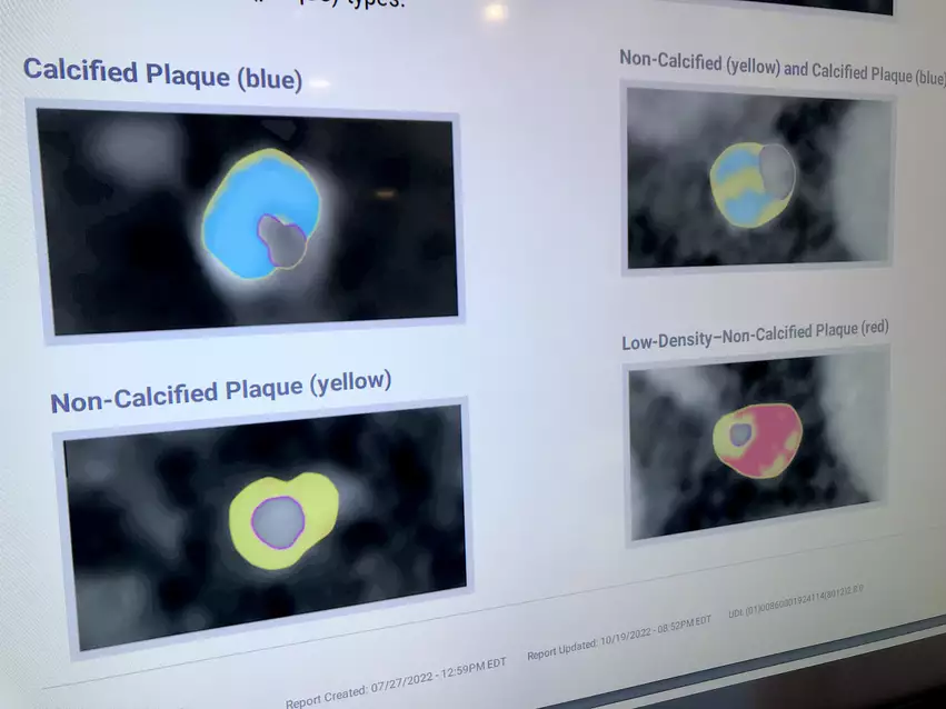 Example of an automated artificial intelligence (AI) assessment of soft coronary plaque from a CT scan from the vendor Cleerly. this image shows the different types of soft plaques the system can identify.