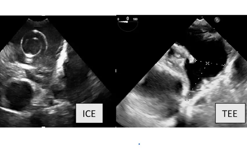 A comparison of imaging of the same LAA anatomy between intra-cardiac echo (ICE) and transesophageal echo (TEE) in the new SCAI and HRS LAA occlusion consensus document. Some operators are using 3D/4D ICE to guide procedures to eliminate the need for an anesthesiologist and the ability to use conscience sedation.