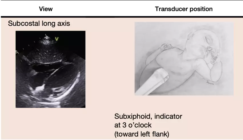 A figure from the ASE pediatric POCUS guidelines showing how a sonographer can get specific imaging views and position of the transducer during POCUS exams.