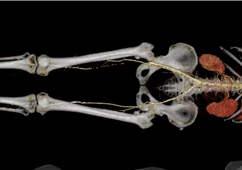 Peripheral artery disease (PAD) in the legs seen in a CT runoff exam. Canon Medical Systems image.