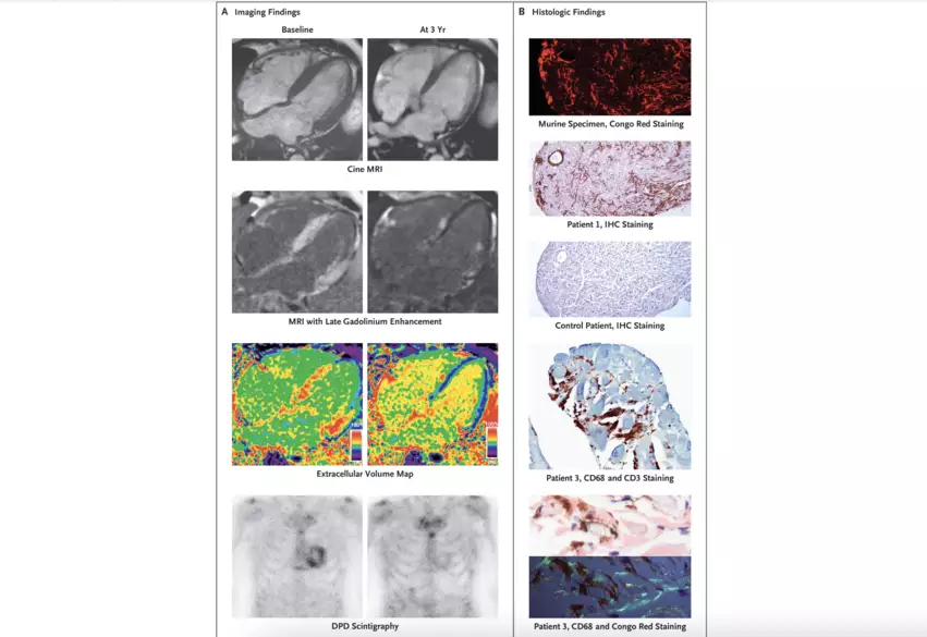 Imaging and Histologic Findings in Patients with Antibody-Associated Cardiac Amyloid Regression.