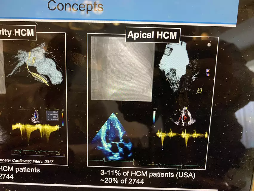 Example of an echocardiogram showing apical hypertrophic cardiomyopathy (HCM). At the American Society of Echocardiography (ASE) 2023 meeting.