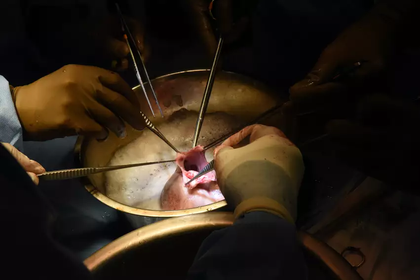 Surgeons transplanting a pig heart into a human patient. 