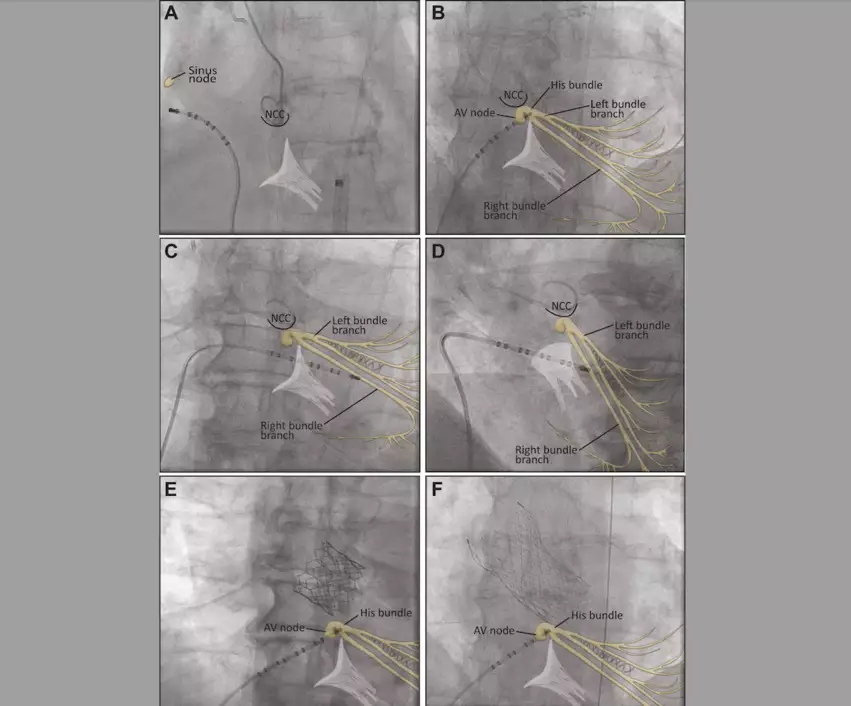 electrophysiology studies during TAVR procedures appear to be safe and effective