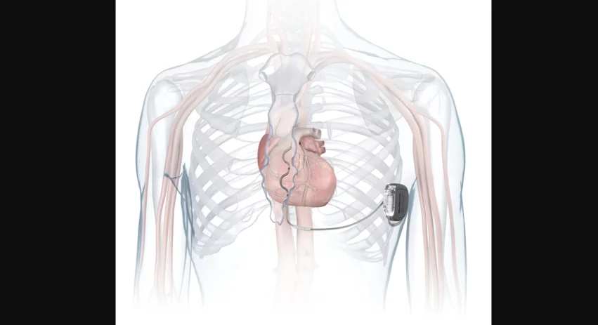Medtronic extravascular ICD Aurora EV-ICD MRI SureScan
