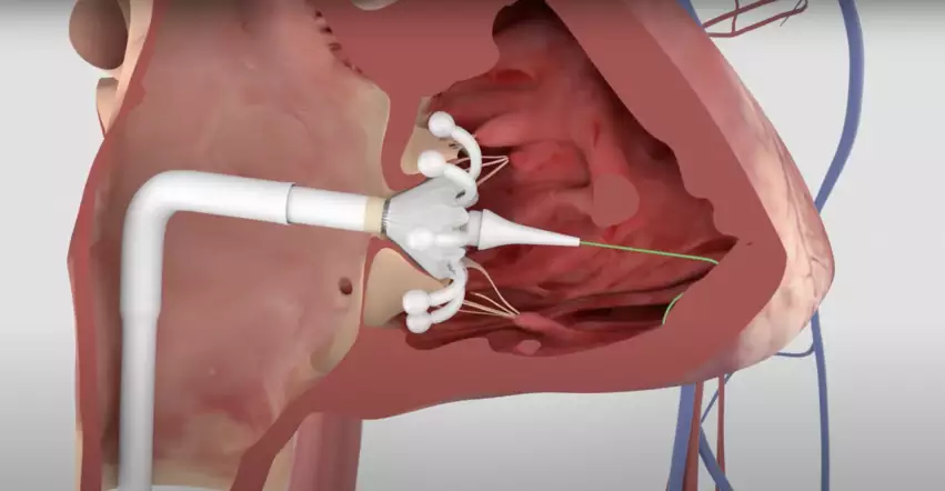 The Evoque transcatheter tricuspid valve replacement (TTVR) system for tricuspid regurgitation from Edwards Lifesciences. The Evoque is the first transcatheter tricuspid valve approved by the FDA. It is the first TTVR cleared in the U.S.