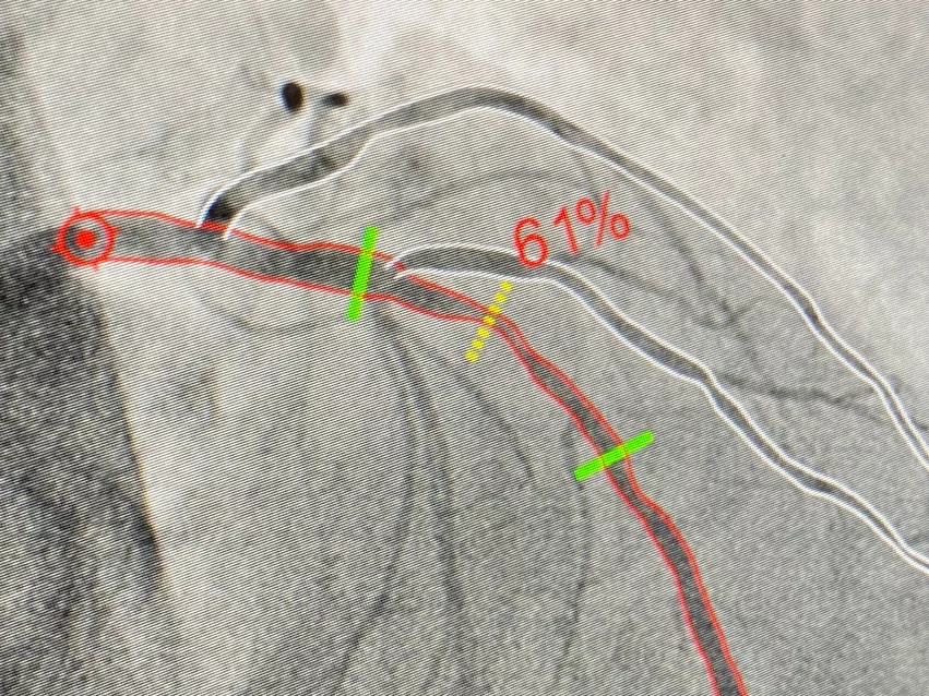 CathWorks FFRAngio vessel assessment in the cath lab for PCI displayed at TCT 2023. Photo by Dave Fornell