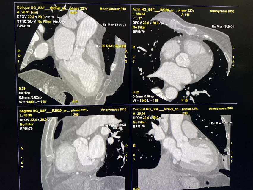 Heart, cardiac CT with aortic stenosis images using a GE Revolution Apex CT system at RSNA 2023. Photo by Dave Fornell