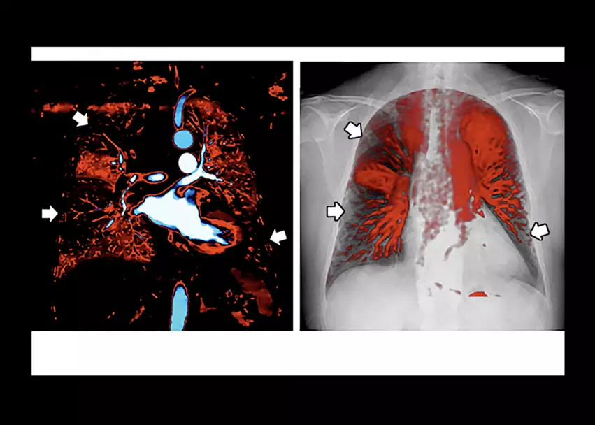 "Dynamic Chest Radiography of Acute Pulmonary Thromboembolism,” RSNA