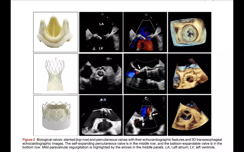 American Society of Echocardiography biological prosthetic heart valves. New guidelines from the American Society of Echocardiography, made in collaboration with the Society for Cardiovascular Magnetic Resonance and Society of Cardiovascular Computed Tomography, represent an update of the group's original recommendations from 2009.