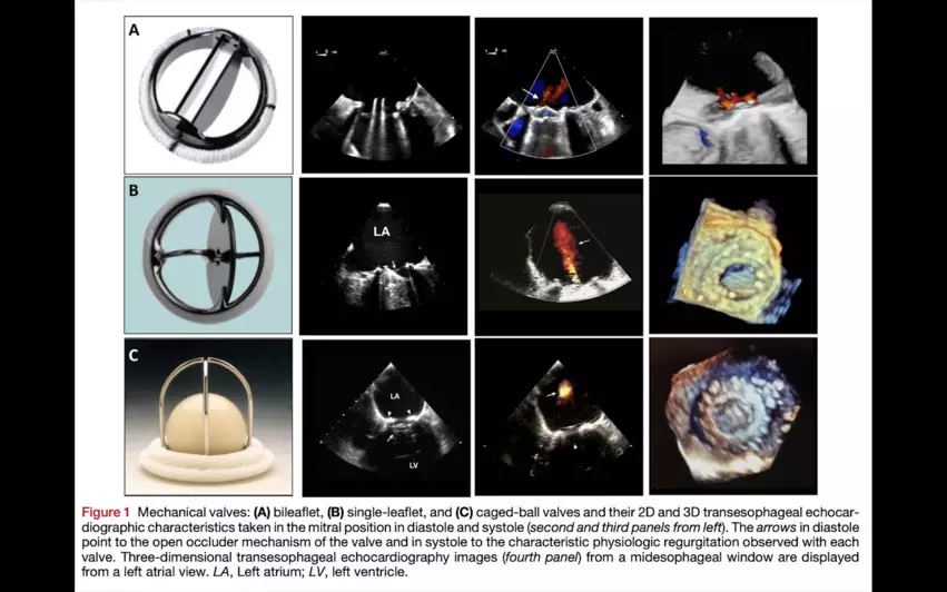 American Society of Echocardiography mechanical prosthetic heart valves. The American Society of Echocardiography (ASE) has published new recommendations on the evaluation of prosthetic heart valve (PHV) function using cardiovascular imaging. The document, made in collaboration with both the Society for Cardiovascular Magnetic Resonance (SCMR) and Society of Cardiovascular Computed Tomography (SCCT), represents an update of ASE’s original guidelines on the topic from 2009.