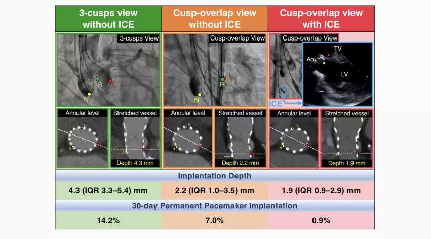 Utilizing the TAVR cusp-overlap method can help keep the permanent pacemaker implant (PPI) rate low when using self-expandable TAVR devices, according to new research published in Circulation: Cardiovascular Intervention.