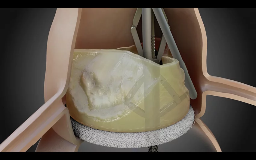 Pi-Cardia ShortCut TAVR device. According to Pi-Cardia, ShortCut is the first medical device of its kind; interventional cardiologists use it to split valve leaflets in patients who have been recommended for valve-in-valve TAVR and face a heightened coronary obstruction risk.