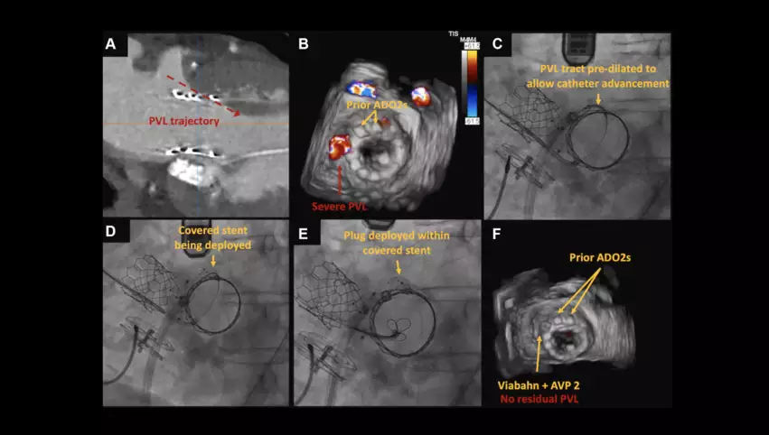 Treating mitral PVL with the Tootsie Roll technique in which a covered stent is inserted into the leak to turn the hole into a conduit and thgen an Amplatzer vascular plug is used to occlude the covered stent and seal the PVL. Images courtesy of Ueyama et al.tootsie roll technique paravalvular leak