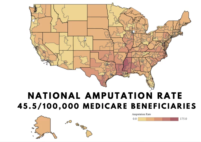 U.S. map of leg amputation prevalence based on Medicare data, showing Mississippi delta region having the largest number due to high incidence of peripheral artery disease (PAD). Image courtesy of Foluso Fakorede, MD