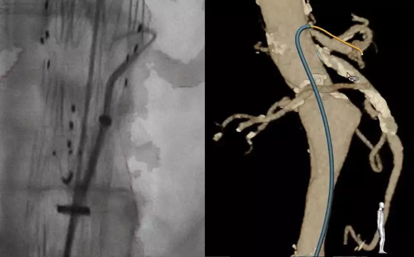 A comparison with traditional angiography, left, and the new Philips LumiGuide FORS imaging of an aorta with a stent graft.