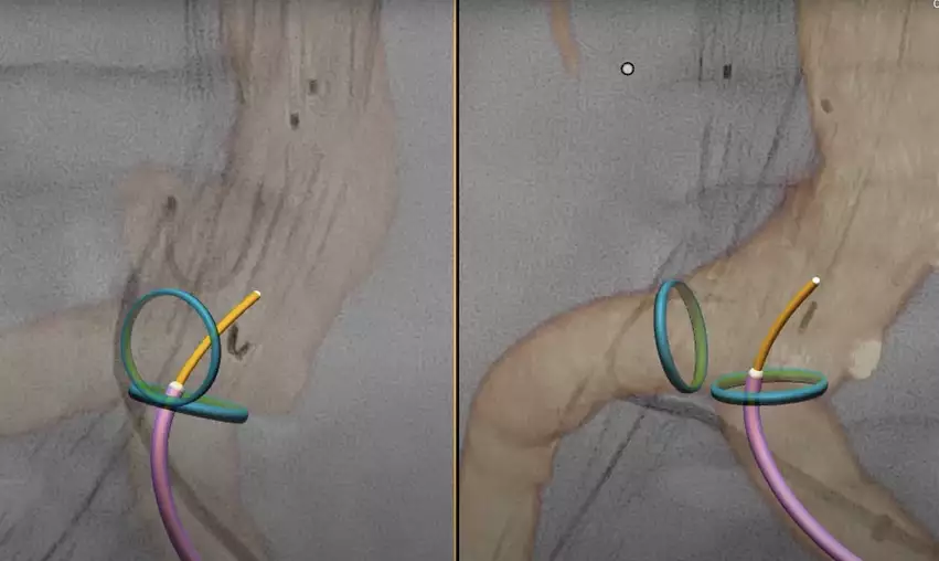 Philips LumiGuide FORS system showing 2 different views of same catheter entering the aorta from an iliac.