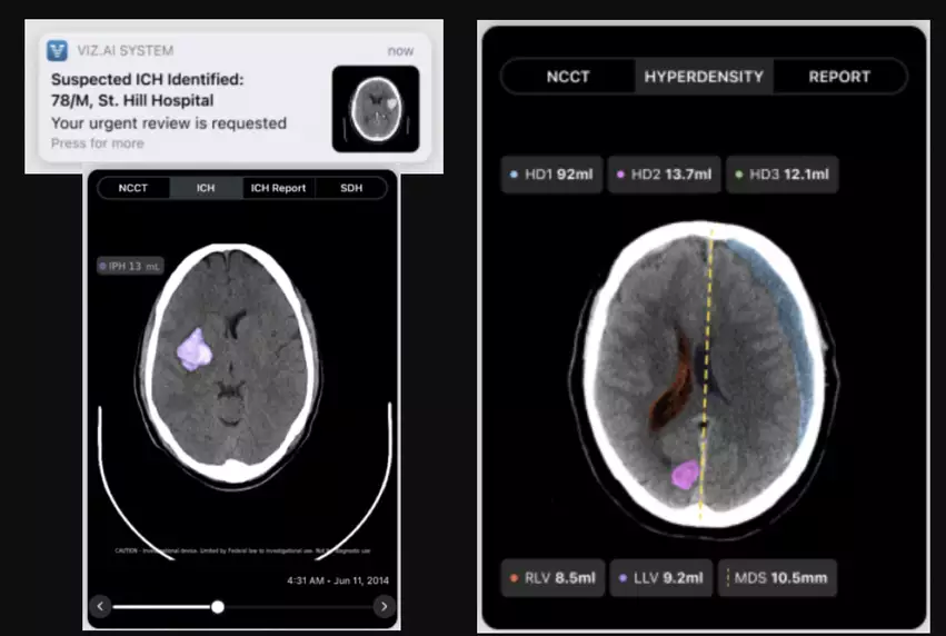 The FDA has cleared Viz.AI's Viz ICH Plus artificial intelligence algorithm, intended to automate the process of identifying, labeling, and quantifying the volume of segmentable brain structures on non-contrast computed tomography (NCCT) images. The Viz ICH Plus software is indicated for analyzing intracranial hyperdensities, lateral ventricles and midline shift, providing volume measurements of brain bleeds for timely and informed treatment decisions.