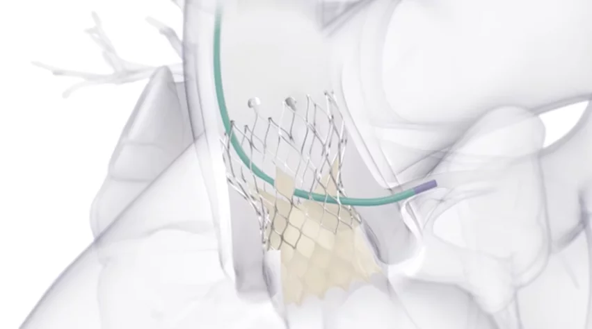 Medtronic's Evolut Pro TAVR valve is designed to treat aortic stenosis.