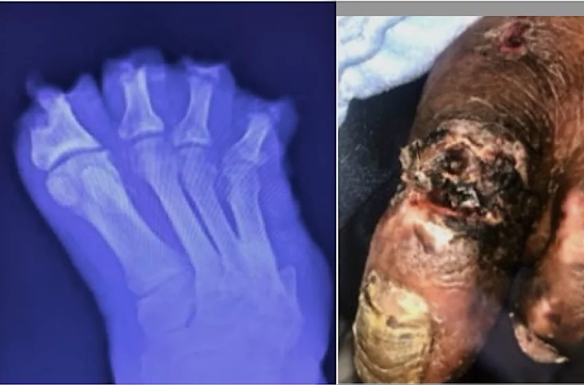 Examples two of Dr. Fakorede's patients who presented with unhealing wounds on toes and feet due to advanced critical limb ischemia (CLI). Prior to him establishing an interventional practice in the area, most of these patient underwent major amputations of the feet or the leg below the knee.