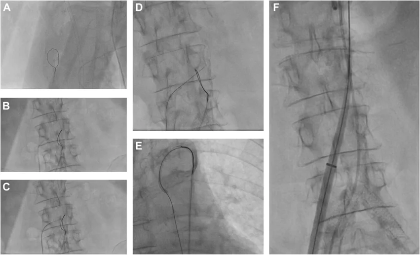 Transcaval crossover from vena cava to abdominal aorta. A loop snare positioned in the aorta and a crossing system placed in the vena cava (A,B). The electrified wire was advanced toward the abdominal aorta (C), where it was snared (D). The snared system was exchanged for a stiff guidewire and the delivery system of the self-expanding clippable device was advanced using the established transcaval access (E, F). Images/caption courtesy of Curio et al., JACC: Case Reports.