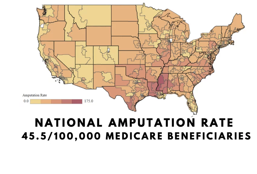 Map of Congressional districts and the rate of amputations based on medicare data showing Mississippi delta region with the highest number of amputation procedures per year. Dr. Fakorede located his practice there to try and combat extremely the high PAD and CLI rates.