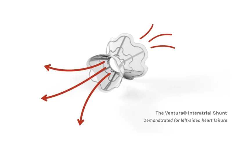 The V-Wave Ventura Interatrial Shunt System