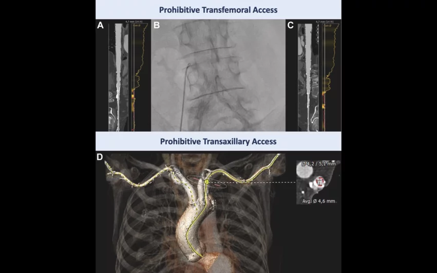 Prohibitive transfemoral and transaxillary access when planning for TAVR for pure AR