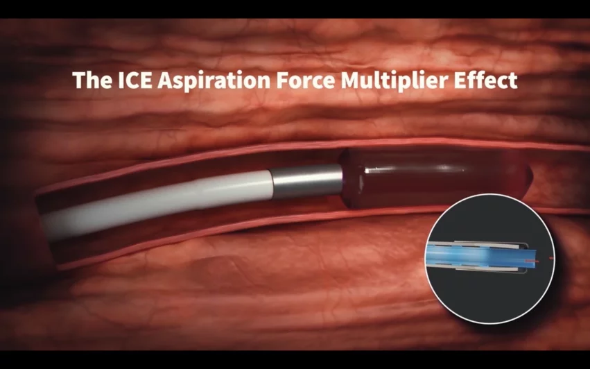 The ICE Aspiration System removing a blood clot