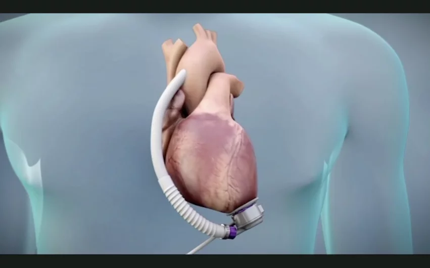 For this latest recall, Abbott is recalling nearly 900 HeartMate 3 LVAD implant kits due to repeated reports of blood leakage or air entering the seal interface between the device’s inflow cannula and apical cuff. This issue has only been seen during the initial implant of the LVAD.